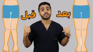 تقوس الساقين